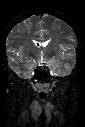 Cerebral arteriovenous malformation at posterior body of corpus callosum (Radiopaedia 74111-84925 Coronal T2 78).jpg
