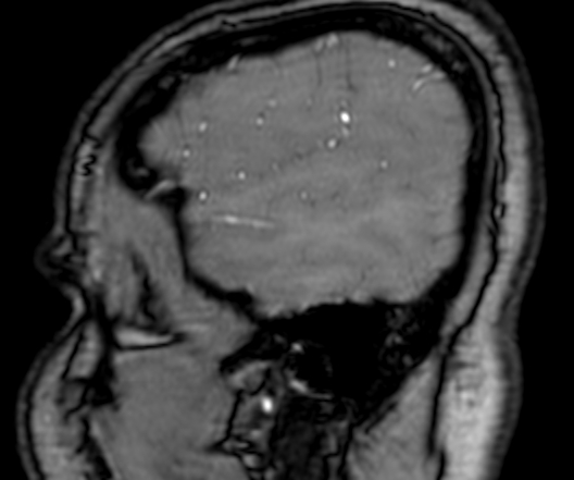 Cerebral arteriovenous malformation at posterior body of corpus callosum (Radiopaedia 74111-84925 J 22).jpg
