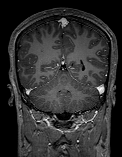 Cerebral arteriovenous malformation at posterior body of corpus callosum (Radiopaedia 74111-84925 K 266).jpg