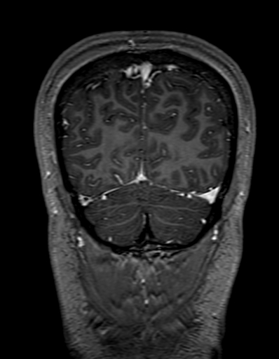 Cerebral arteriovenous malformation at posterior body of corpus callosum (Radiopaedia 74111-84925 K 321).jpg