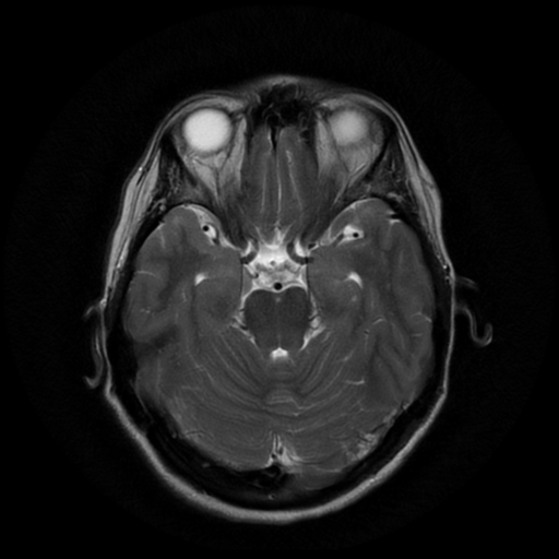 File:Cerebral autosomal dominant arteriopathy with subcortical infarcts and leukoencephalopathy (CADASIL) (Radiopaedia 41018-43768 Ax T2 PROP 7).png