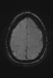 File:Cerebral cavernoma and development venous anomaly (Radiopaedia 37603-39482 Axial SWI 33).png