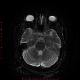 File:Cerebral cavernous malformation (Radiopaedia 26177-26306 Axial DWI 28).jpg