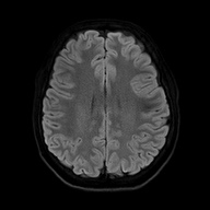 Cerebral cavernous venous malformation (Radiopaedia 70008-80021 Axial DWI 51).jpg