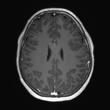 File:Cerebral cavernous venous malformation (Radiopaedia 70008-80021 Axial T1 C+ 56).jpg