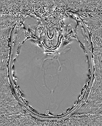 Cerebral cavernous venous malformation (Radiopaedia 70008-80021 G 28).jpg