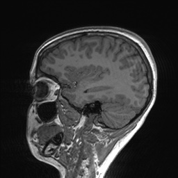 File:Cerebral cavernous venous malformation (Radiopaedia 70008-80021 Sagittal T1 54).jpg