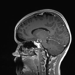 File:Cerebral cavernous venous malformation (Radiopaedia 70008-80021 Sagittal T1 C+ 30).jpg