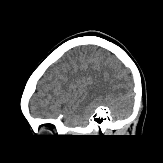 File:Cerebral cavernous venous malformation (Radiopaedia 70008-80022 C 14).jpg