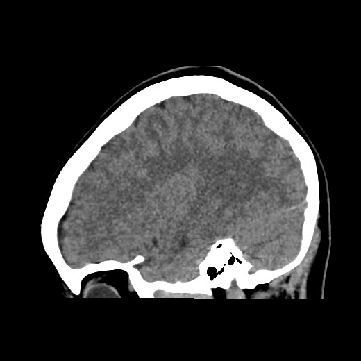 File:Cerebral cavernous venous malformation (Radiopaedia 70008-80022 C 16).jpg