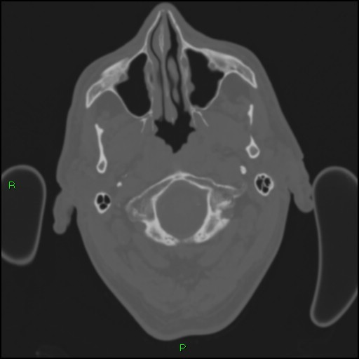 Cerebral contusions (Radiopaedia 33868-35039 Axial bone window 10).jpg