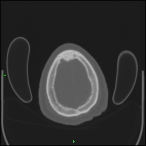 File:Cerebral contusions (Radiopaedia 33868-35039 Axial bone window 205).jpg