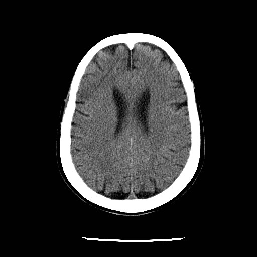 File:Cerebral edema (evolution in time) (Radiopaedia 19418-19441 non-contrast 65).jpg