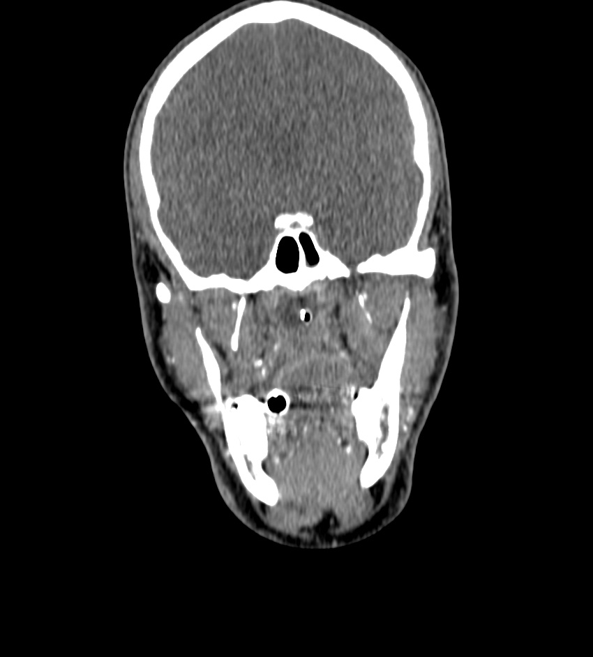 Cerebral edema in an overdose patient (Radiopaedia 72005-82539 B 15).jpg
