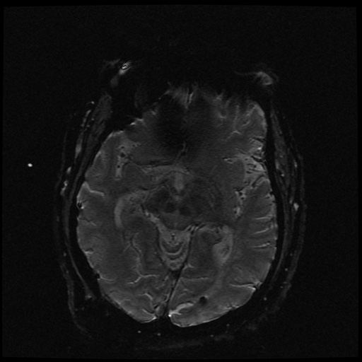 Cerebral embolic infarcts (embolic shower) (Radiopaedia 49837-55108 Axial SWI 43).jpg