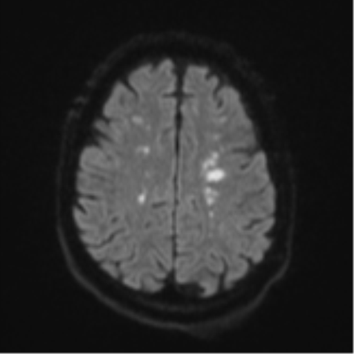 Cerebral embolic infarcts (embolic shower) (Radiopaedia 57395-64342 Axial DWI 62).png