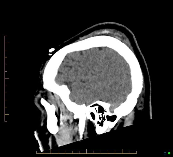 Cerebral fat embolism (Radiopaedia 85521-101224 C 44).jpg