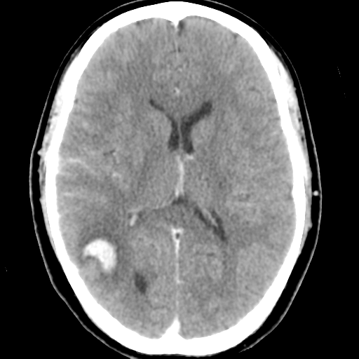 Cerebral hemorrhage secondary to arteriovenous malformation (Radiopaedia 33497-34561 B 30).png
