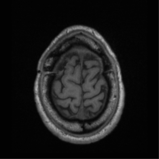 Cerebral hemorrhagic contusions- temporal evolution (Radiopaedia 40224-42757 Axial T1 69).png