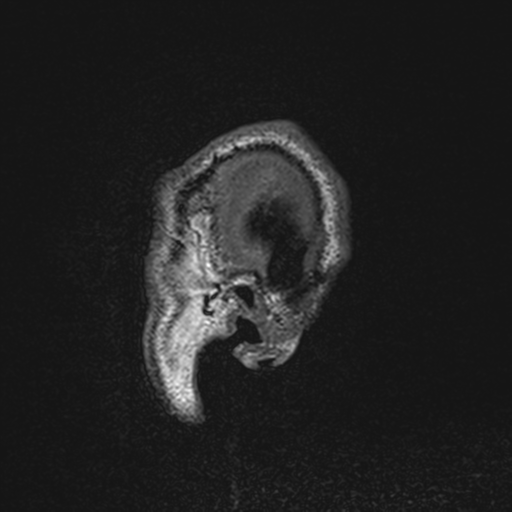 File:Cerebral hemorrhagic contusions- temporal evolution (Radiopaedia 40224-42757 Sagittal T1 5).png