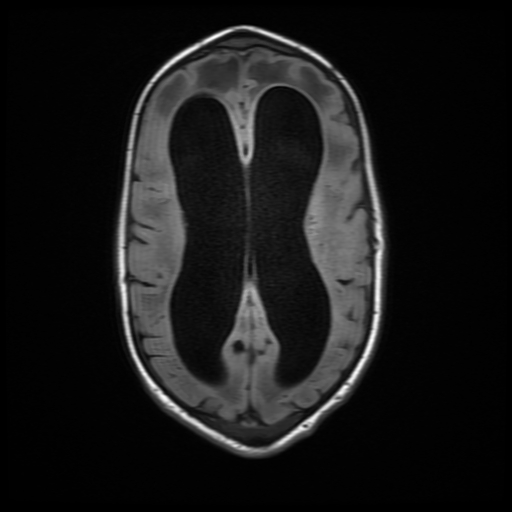 File:Cerebral manifestations of mucopolysaccharidosis type I (Radiopaedia 59171-66487 C 13).jpg