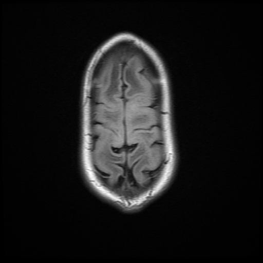 File:Cerebral manifestations of mucopolysaccharidosis type I (Radiopaedia 59171-66487 C 19).jpg