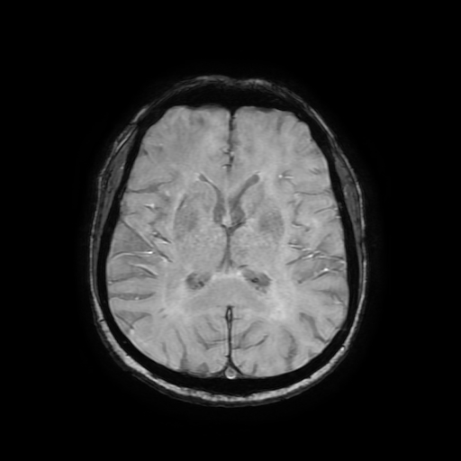 Cerebral metastases - melanoma (Radiopaedia 80972-94522 Axial SWI 56).jpg