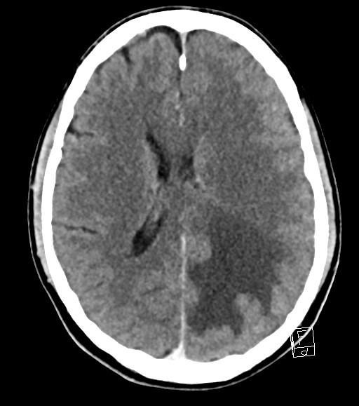 Cerebral metastases - testicular choriocarcinoma (Radiopaedia 84486-99855 Axial C+ delayed 25).jpg