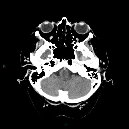 File:Cerebral metastasis from renal cell carcinoma (Radiopaedia 82306-96375 Axial C+ delayed 6).jpg