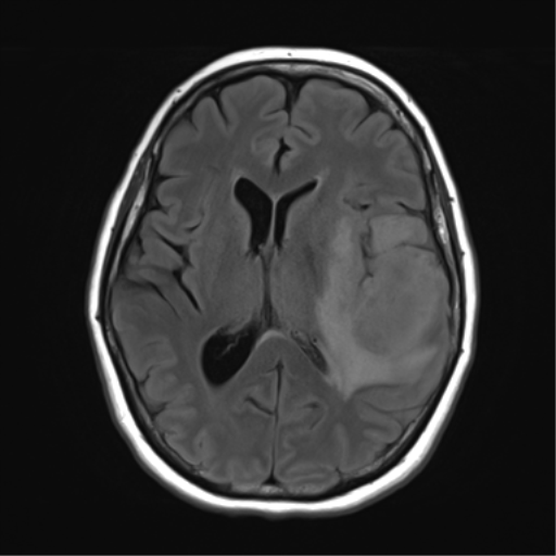 File:Cerebral metastasis mimicking glioblastoma (Radiopaedia 69155-78937 Axial FLAIR 19).png