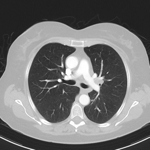 File:Cerebral metastasis mimicking glioblastoma (Radiopaedia 69155-78938 Axial lung window 18).png