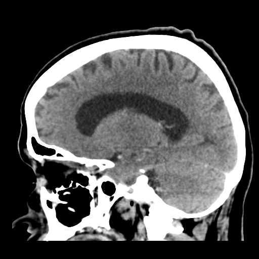 Cerebral metastasis to basal ganglia (Radiopaedia 81568-95412 Sagittal C+ delayed 36).png