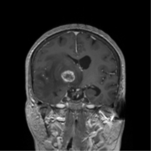 File:Cerebral metastasis to basal ganglia (Radiopaedia 81568-95413 Coronal T1 C+ 28).png