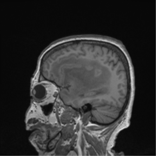 Cerebral metastasis to basal ganglia (Radiopaedia 81568-95413 Sagittal T1 57).png