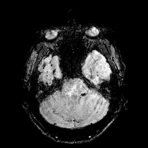 Cerebral parenchymal arteriovenous malformation (Radiopaedia 27280-27456 Axial SWI 24).jpg