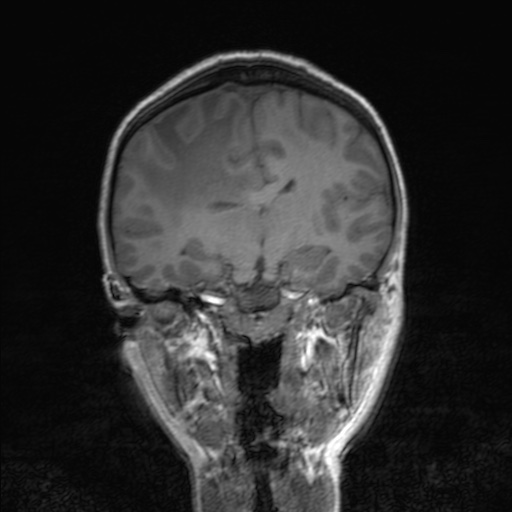 Cerebral tuberculosis with dural sinus invasion (Radiopaedia 60353-68090 Coronal T1 99).jpg