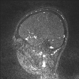 Cerebral tuberculosis with dural sinus invasion (Radiopaedia 60353-68090 Sagittal MRV 119).jpg