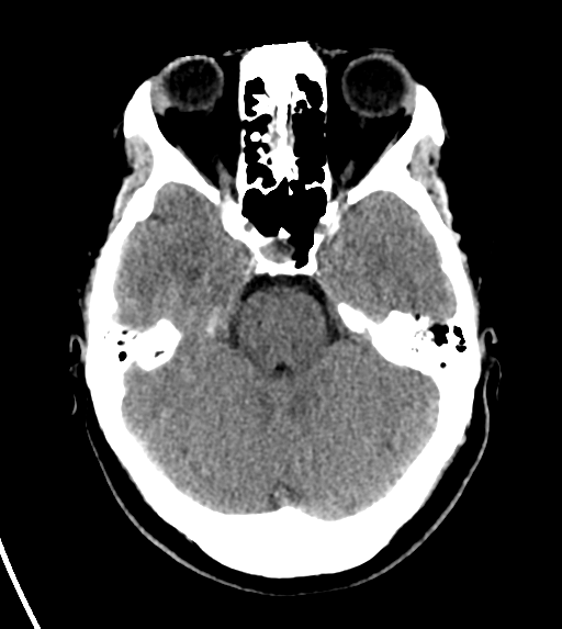 File:Cerebral venous infarct related to dural venous sinus thromboses (Radiopaedia 35292-36804 Axial non-contrast 10).png