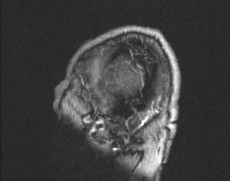 Cerebral venous infarction (Radiopaedia 65166-74176 Sagittal TOF 6).jpg