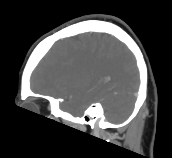 Cerebral venous infarction due to transverse sinus thrombosis (Radiopaedia 34688-36120 Sagittal CT venogram 38).png