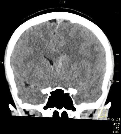 Cerebral venous sinus thrombosis (Radiopaedia 91329-108965 Coronal non-contrast 22).jpg