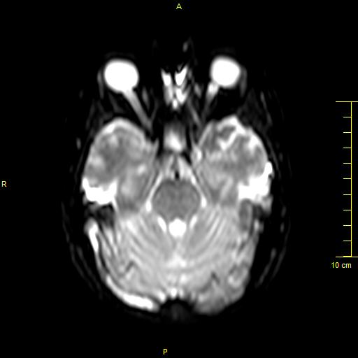 File:Cerebral venous thrombosis (Radiopaedia 23288-23351 Axial DWI 10).JPG