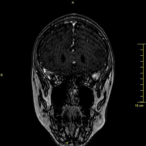 Cerebral venous thrombosis (Radiopaedia 23288-23351 MRV 21).JPG