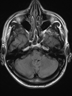 File:Cerebral venous thrombosis (Radiopaedia 38392-40469 Axial FLAIR 6).png