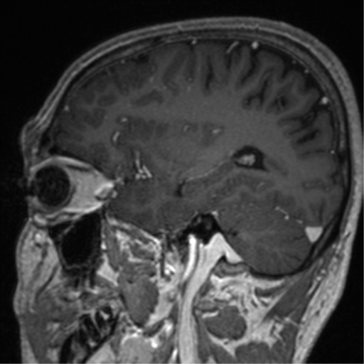 File:Cerebral venous thrombosis (Radiopaedia 38392-40469 Sagittal T1 C+ 30).png