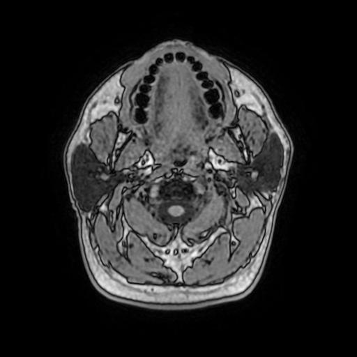 File:Cerebral venous thrombosis with secondary intracranial hypertension (Radiopaedia 89842-106957 Axial T1 12).jpg