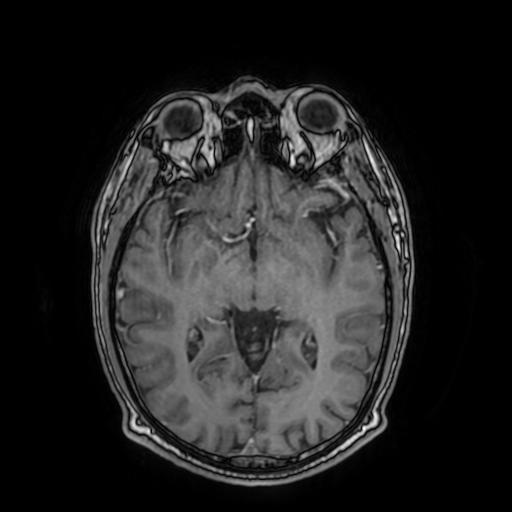 File:Cerebral venous thrombosis with secondary intracranial hypertension (Radiopaedia 89842-106957 Axial T1 C+ 88).jpg
