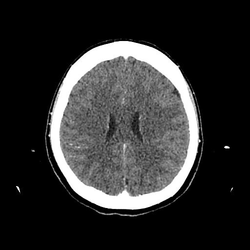 Cerebral venous thrombosis with venous hemorrhagic infarct (Radiopaedia 90354-107660 Axial with contrast 109).jpg