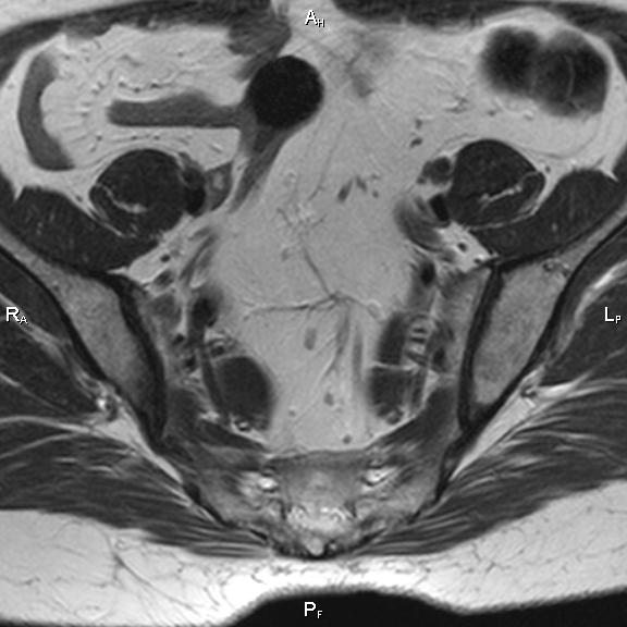 File:Cervical adenocarcinoma (Radiopaedia 65011-73985 Axial T2 32).jpg