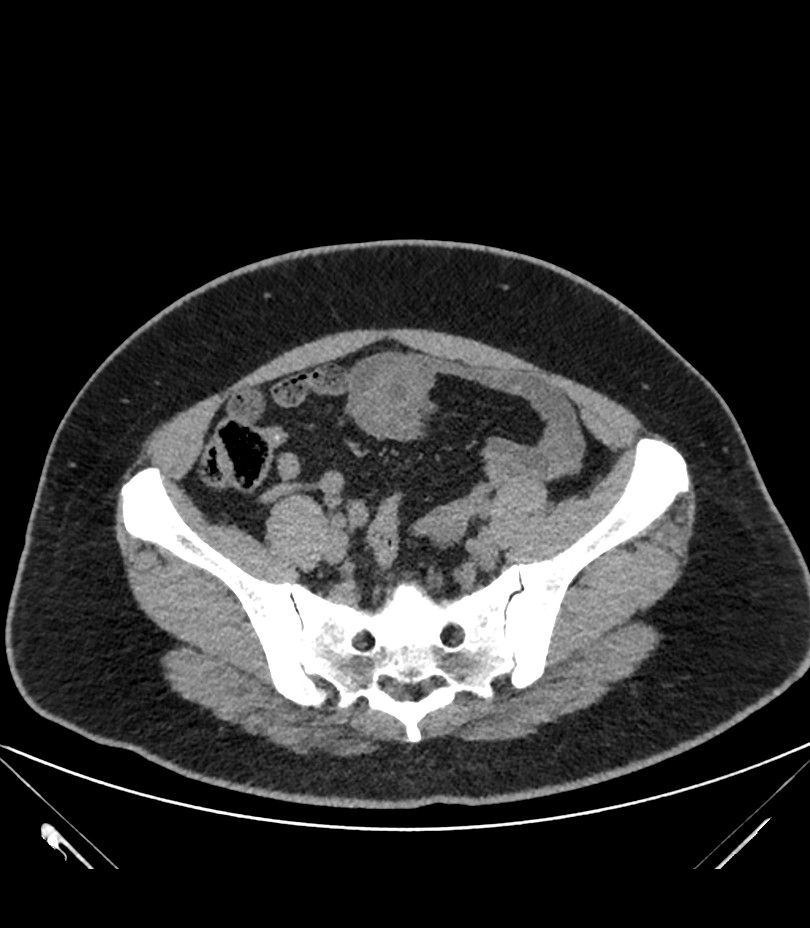 Cervical aortic arch with coarctation and aneurysms (Radiopaedia 44035-47552 Axial non-contrast 81).jpg